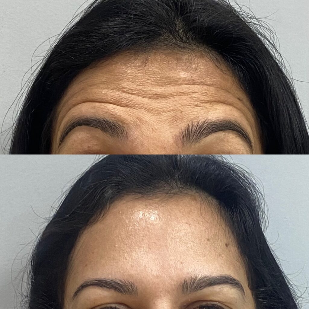 botox